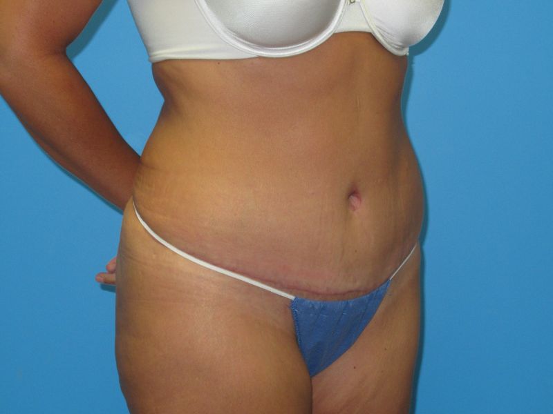 How fat around your organs can affect tummy tuck results